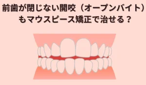 前歯が閉じない開咬（オープンバイト）もマウスピース矯正で治せる？ アイキャッチ